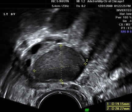 endometrioma-ultrasound