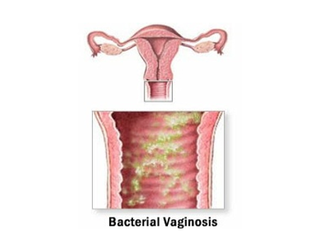 bacterial-vaginosis.jpg