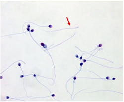 Đột biến SUN5 mới liên quan đến hội chứng tinh trùng không đầu