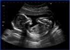 fetus ultrasound1