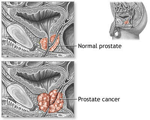 prostate-cancer_1