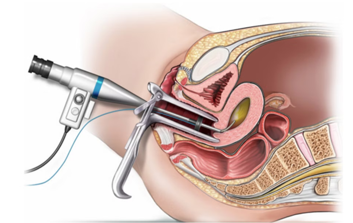 Tổng quan hiệu quả nội soi buồng tử cung chẩn đoán trong hỗ trợ sinh sản
