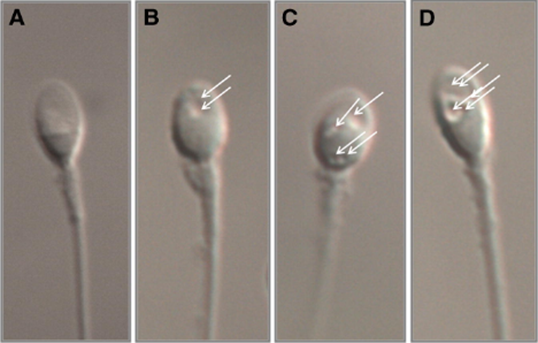 Hiệu quả và thách thức của kỹ thuật tiêm tinh trùng được chọn lọc hình thái vào bào tương noãn - IMSI (Intracytoplasmic morphologically selected sperm injection)
